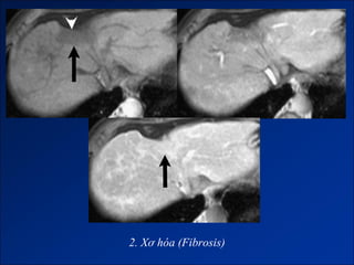 2. Xơ hóa (Fibrosis)
 