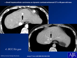 —Small hepatocellular carcinoma on dynamic contrast-enhanced CT in 49-year-old man.




         4. HCC/Xơ gan

©2005 by American Roentgen Ray Society   Jeong Y Y et al. AJR 2005;185:1024-1032
 