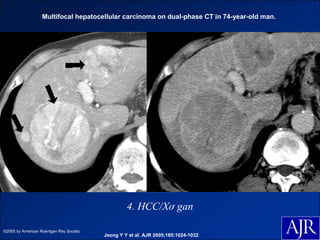 Multifocal hepatocellular carcinoma on dual-phase CT in 74-year-old man.




                                                  4. HCC/Xơ gan

©2005 by American Roentgen Ray Society
                                         Jeong Y Y et al. AJR 2005;185:1024-1032
 