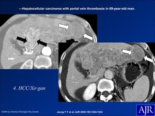 —Hepatocellular carcinoma with portal vein thrombosis in 69-year-old man.




           4. HCC/Xơ gan



©2005 by American Roentgen Ray Society   Jeong Y Y et al. AJR 2005;185:1024-1032
 