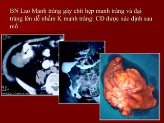 Dày thành ruột non
 CT: Nhiều đoạn ruột
non thành dày nhẹ
 b,c: Thành ruột dày
đồng tín hiệu trên T2
FS.
 d,e: thành dà...