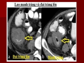 Hình ảnh CLVT Lao phúc mạc
 Lao phúc mạc chủ yếu được biểu hiện trên CT bằng các mức độ thâm nhiễm mạc
treo ruột và / hoặ...