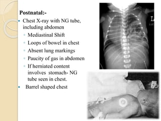 Postnatal:-
 Chest X-ray with NG tube,
including abdomen
◦ Mediastinal Shift
◦ Loops of bowel in chest
◦ Absent lung markings
◦ Paucity of gas in abdomen
◦ If herniated content
involves stomach- NG
tube seen in chest.
 Barrel shaped chest
 