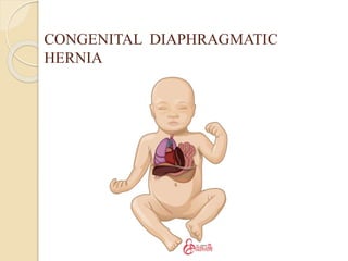 CONGENITAL DIAPHRAGMATIC
HERNIA
 