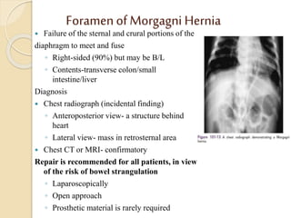 Foramen of Morgagni Hernia
 Failure of the sternal and crural portions of the
diaphragm to meet and fuse
◦ Right-sided (90%) but may be B/L
◦ Contents-transverse colon/small
intestine/liver
Diagnosis
 Chest radiograph (incidental finding)
◦ Anteroposterior view- a structure behind
heart
◦ Lateral view- mass in retrosternal area
 Chest CT or MRI- confirmatory
Repair is recommended for all patients, in view
of the risk of bowel strangulation
◦ Laparoscopically
◦ Open approach
◦ Prosthetic material is rarely required
 
