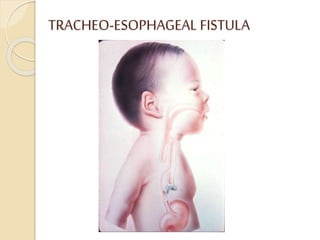 TRACHEO-ESOPHAGEAL FISTULA
 