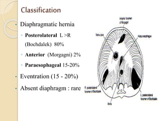 Classification
• Diaphragmatic hernia
◦ Posterolateral L >R
(Bochdalek) 80%
◦ Anterior (Morgagni) 2%
◦ Paraesophageal 15-20%
• Eventration (15 - 20%)
• Absent diaphragm : rare
 