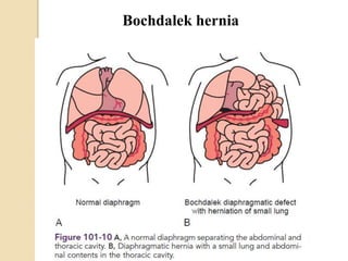 Bochdalek hernia
 