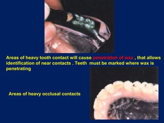 Tooth Contact Exceptions Complete Denture insertion | PPT