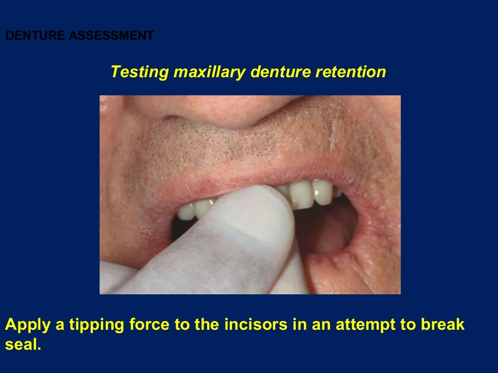 Complete Denture insertion
