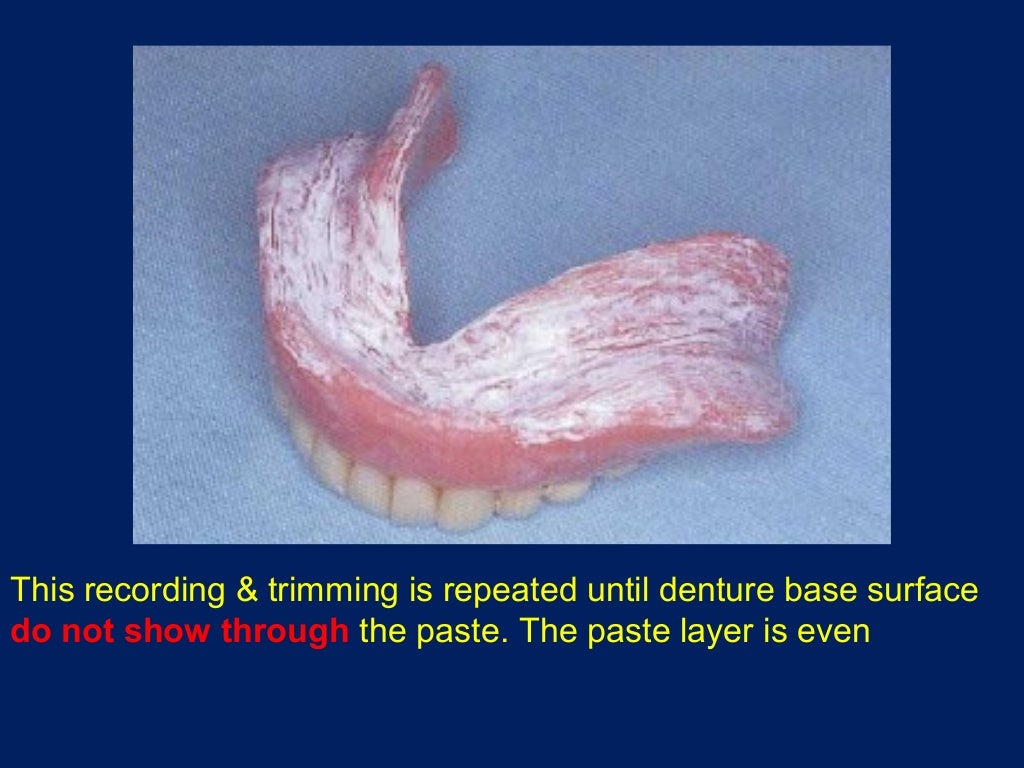 Complete Denture insertion