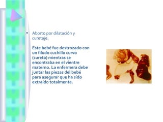 • Aborto por dilatación y
curetaje.
Este bebé fue destrozado con
un filudo cuchillo curvo
(cureta) mientras se
encontraba en el vientre
materno. La enfermera debe
juntar las piezas del bebé
para asegurar que ha sido
extraído totalmente.
 