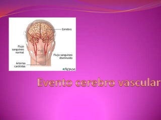 Evento cerebro vascular 
