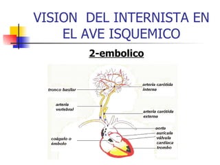 VISION  DEL INTERNISTA EN EL AVE ISQUEMICO 2-embolico 