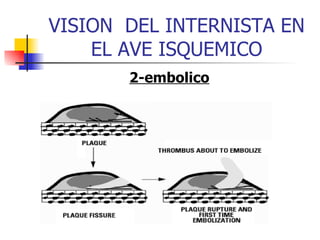 VISION  DEL INTERNISTA EN EL AVE ISQUEMICO 2-embolico 