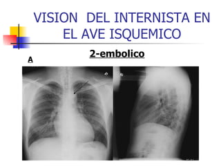 VISION  DEL INTERNISTA EN EL AVE ISQUEMICO 2-embolico A 