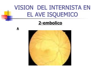 VISION  DEL INTERNISTA EN EL AVE ISQUEMICO 2-embolico A 