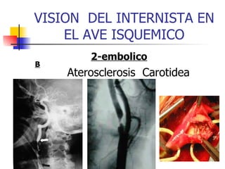 VISION  DEL INTERNISTA EN EL AVE ISQUEMICO 2-embolico Aterosclerosis  Carotidea B 