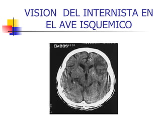 VISION  DEL INTERNISTA EN EL AVE ISQUEMICO 