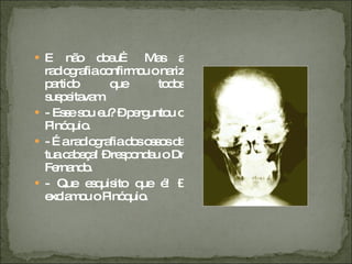 E não doeu… Mas a radiografia confirmou o nariz partido que todos suspeitavam. - Esse sou eu? – perguntou o Pinóquio. - É a radiografia dos ossos da tua cabeça! – respondeu o Dr Fernando.  - Que esquisito que é! – exclamou o Pinóquio. 