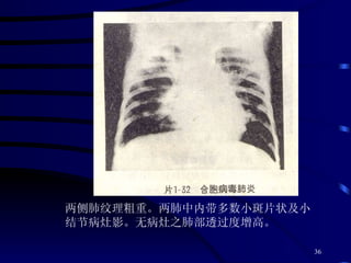 两侧肺纹理粗重。两肺中内带多数小斑片状及小结节病灶影。无病灶之肺部透过度增高。 