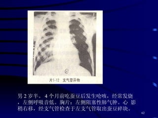 男 2 岁半。 4 个月前吃蚕豆后发生呛咳，经常发烧，左侧呼吸音低。胸片：左侧阻塞性肺气肿。心 影稍右移，经支气管检查于左支气管取出蚕豆碎块。 