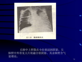 右肺中上野散在小灶状浸润阴影。左肺野中外带见大片状融合状阴影。其余肺野含气量增高。 