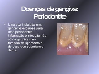 Doenças da gengiva:  Periodontite Uma vez instalada uma gengivite evolui-se para uma periodontite, inflamação e infecção não só da gengiva mas também do ligamento e do osso que suportam o dente. 