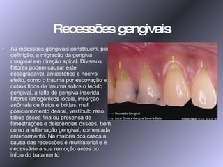 Recessões gengivais As recessões gengivais constituem, por definição, a migração da gengiva marginal em direção apical. Diversos fatores podem causar este desagradável, antiestético e nocivo efeito, como o trauma por escovação e outros tipos de trauma sobre o tecido gengival, a falta de gengiva inserida, fatores iatrogênicos locais, inserção anômala de freios e bridas, mal posicionamento dental, vestíbulo raso, tábua óssea fina ou presença de fenestrações e deiscências ósseas, bem como a inflamação gengival, comentada anteriormente. Na maioria dos casos a causa das recessões é multifatorial e é necessário a sua remoção antes do início do tratamento  