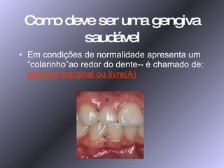 Como deve ser uma gengiva saudável Em condições de normalidade apresenta um “colarinho”ao redor do dente-- é chamado de:   gengiva marginal ou livre(A) 