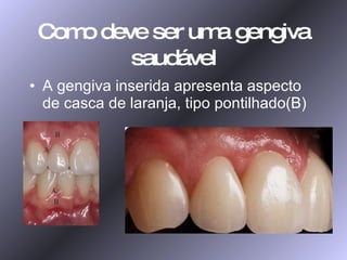 Como deve ser uma gengiva saudável A gengiva inserida apresenta aspecto de casca de laranja, tipo pontilhado(B) 