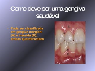 Como deve ser uma gengiva saudável Pode ser classificada em gengiva marginal (A) e inserida (B), ambas queratinizadas 