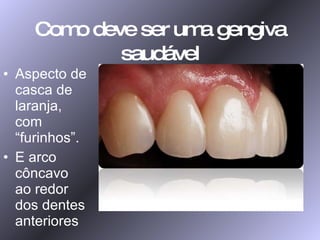 Como deve ser uma gengiva saudável Aspecto de casca de laranja, com “furinhos”. E arco côncavo ao redor dos dentes anteriores 