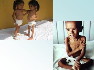 La desnutrición puede ser primaria también llamada desnutrición leve, o desnutrición secundaria.Un Niño Desnutrido se caracteriza por:Bajo de peso.