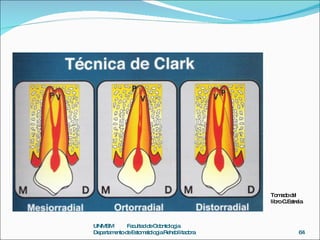 UNMSM  Facultad de Odontologia  Departamento de Estomatologia Rehabilitadora Tomado del libro C.Estrela 