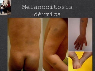 Melanocitosis dérmica 