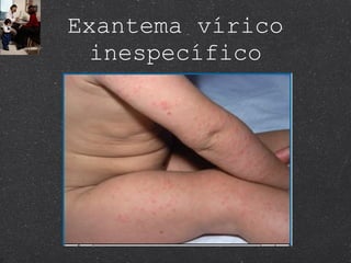 Exantema vírico inespecífico 
