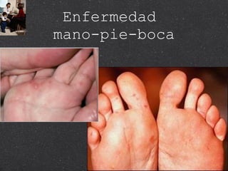 Enfermedad  mano-pie-boca 