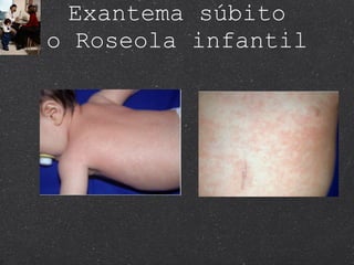 Exantema súbito o Roseola infantil 
