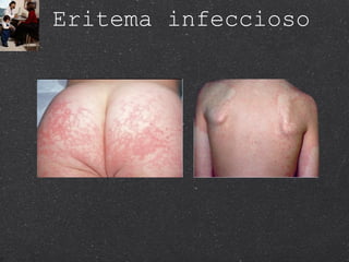 Eritema infeccioso  
