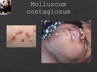 Molluscum contagiosum 