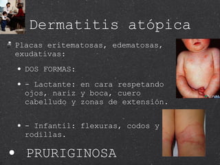 Dermatitis atópica Placas eritematosas, edematosas, exudativas: DOS FORMAS:  - Lactante: en cara respetando ojos, nariz y boca, cuero cabelludo y zonas de extensión.  - Infantil: flexuras, codos y rodillas. PRURIGINOSA 