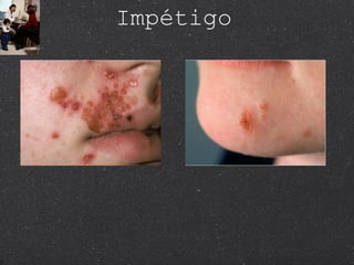 Impétigo 