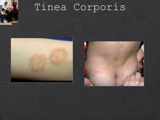 Tinea Corporis 