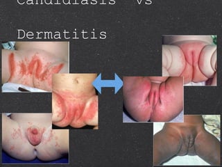 Candidiasis  vs  Dermatitis 