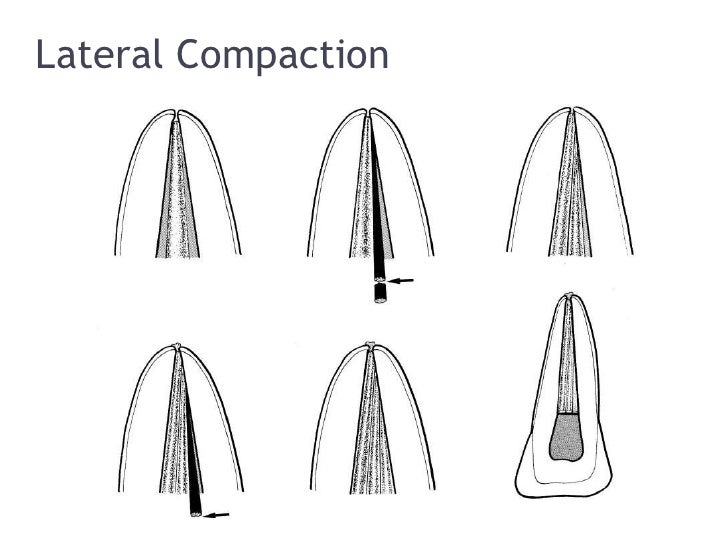 3rd year Obturation Lecture