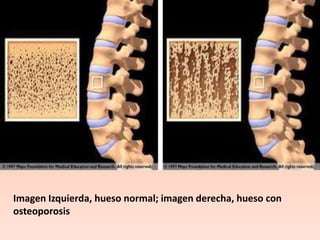 Imagen Izquierda, hueso normal; imagen derecha, hueso con osteoporosis