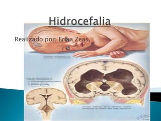 Hidrocefalia Realizado por: Erika Zeas. 
