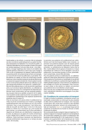 LES DIFFICULTÉS D’INTERPRÉTATION EN… BACTÉRIOLOGIE




          Figure 1 – Exemple d’une contamination                           Figure 2 – Présence de plus de 3 espèces
                     par la ﬂore urétrale.                                 bactériennes chez un patient non sondé.




                                                                   Il s’agit d’une urine mal prélevée et conservée plusieurs heures à
 Ici trois espèces différentes sont présentes.                     température ambiante avant d’être acheminée au laboratoire.



handicapées ou les enfants. Le premier rôle du biologiste         La ponction sus-pubienne et le prélèvement par cathé-
est donc de décrire systématiquement au patient les éta-          térisme sont des techniques fiables mais invasives. La
pes nécessaires à la réalisation d’un recueil de qualité. La      ponction sus-pubienne expose à peu de risques graves
méthode habituellement recommandée consiste à récupérer           mais nécessite une indication rigoureuse et une équipe
de manière aseptique l’urine de milieu de jet, « à la volée »,    entraînée. Le cathétérisme de réalisation facile chez la
après un lavage hygiénique des mains et une toilette des          fille, s’avère délicat chez le garçon et expose à un risque
organes génitaux externes au savon doux puis rinçage à            traumatique de l’urètre et à une IU iatrogène. Lors de ce
l’eau ou par un antiseptique non agressif. Après évacuation       prélèvement, les premières gouttes d’urines, potentielle-
du premier jet (20 ml) contaminé par la flore commensale,         ment contaminées, doivent être éliminées.
au moins 20 à 30 ml sont recueillis dans un pot stérile. Pour     Pour les patients porteurs d’urétérostomie, un collecteur
les patients non valides, le niveau de contamination semble       stérile est utilisé après désinfection soigneuse de la peau.
beaucoup moins important lorsque le recueil est effectué par      Chez la personne incontinente ou handicapée, le recueil doit
un personnel soignant entraîné [4]. Chez le patient sondé,        s’effectuer en priorité par un personnel soignant après une
l’urine ne sera jamais prélevée dans le sac collecteur ou par     toilette génitale soigneuse. Chez la femme, le cathétérisme
des manœuvres entraînant une rupture du « système clos ».         est conseillé si la miction est impossible. Chez l’homme,
Elle doit être prélevée dans un site de ponction spécifique       on peut utiliser un étui pénien ou réaliser une ponction
prévu sur la sonde et après désinfection, ou collectée sur        sus-pubienne lors d’une rétention urinaire aiguë.
une sonde neuve lors d’un changement de dispositif pour           Dans tous les cas, le prélèvement est fermé hermétique-
éliminer toute contamination par des bactéries adhéren-           ment, précisément identifié et accompagné d’une pres-
tes à la paroi interne du cathéter urinaire [5, 6]. En réalité,   cription détaillée.
chez le patient sondé, seule la ponction sus-pubienne est
complètement représentative des espèces bactériennes              3.2. Conditions de conservation et transport
présentes dans la vessie [7].                                     Il s’agit ici d’éviter la pullulation microbienne suivant une
Chez le nourrisson et le jeune enfant, le prélèvement au          éventuelle contamination en diminuant le plus possible
milieu du jet est une technique non invasive, à privilégier       le délai entre le prélèvement et l’analyse. Une mauvaise
systématiquement chez les enfants qui ont une miction             conservation des urines peut conduire à des résultats
volontaire. Avec un peu de patience, il est même pos-             de bactériurie aberrants, surtout si la contamination ini-
sible de recueillir de cette façon l’urine d’un très jeune        tiale est importante (ﬁgure 2). Le principal risque est de
enfant ou même d’un nourrisson qui urine toutes les               surestimer la bactériurie et d’inciter le clinicien à traiter
demi-heures. La contamination par la flore périnéale et           inutilement le patient.
digestive est réduite par une désinfection soigneuse de           De nombreuses études soulignent depuis longtemps l’im-
la vulve, du prépuce ou du gland. En routine, la technique        portance majeure d’un transport rapide et d’une température
la plus utilisée est la collecte d’urine sur poche à urine        de conservation adaptée pour éviter la multiplication des
adhésive. Cette technique nécessite une désinfection              bactéries contaminantes [8, 9, 10]. À partir de la 3-4e heure,
cutanée extrêmement rigoureuse et un temps de pose                il existe une augmentation de la bactériurie de l’ordre
bref (< 30 minutes).                                              de 1 log10 entre les urines placées à 22 °C et les urines

                                                                       REVUE FRANCOPHONE DES LABORATOIRES - NOVEMBRE 2008 - N°406 //    53
 