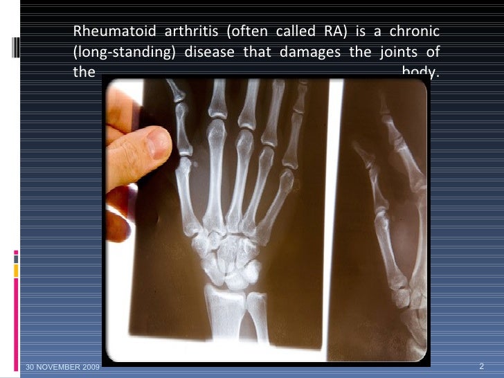 RHEUMATOID ARTHRITIS